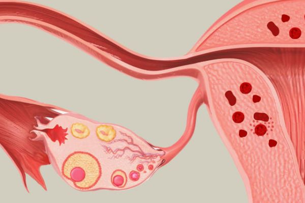 Adenomiose
