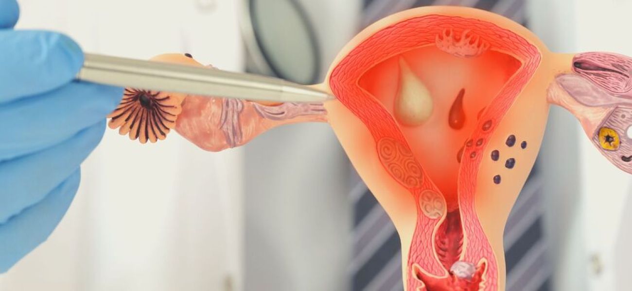 endometrite cronica