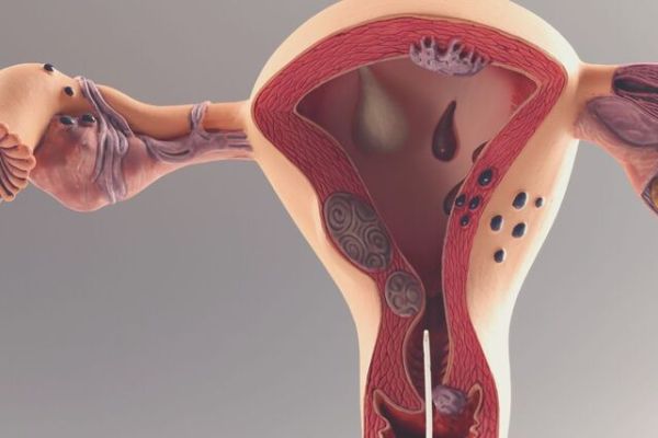 endometrio