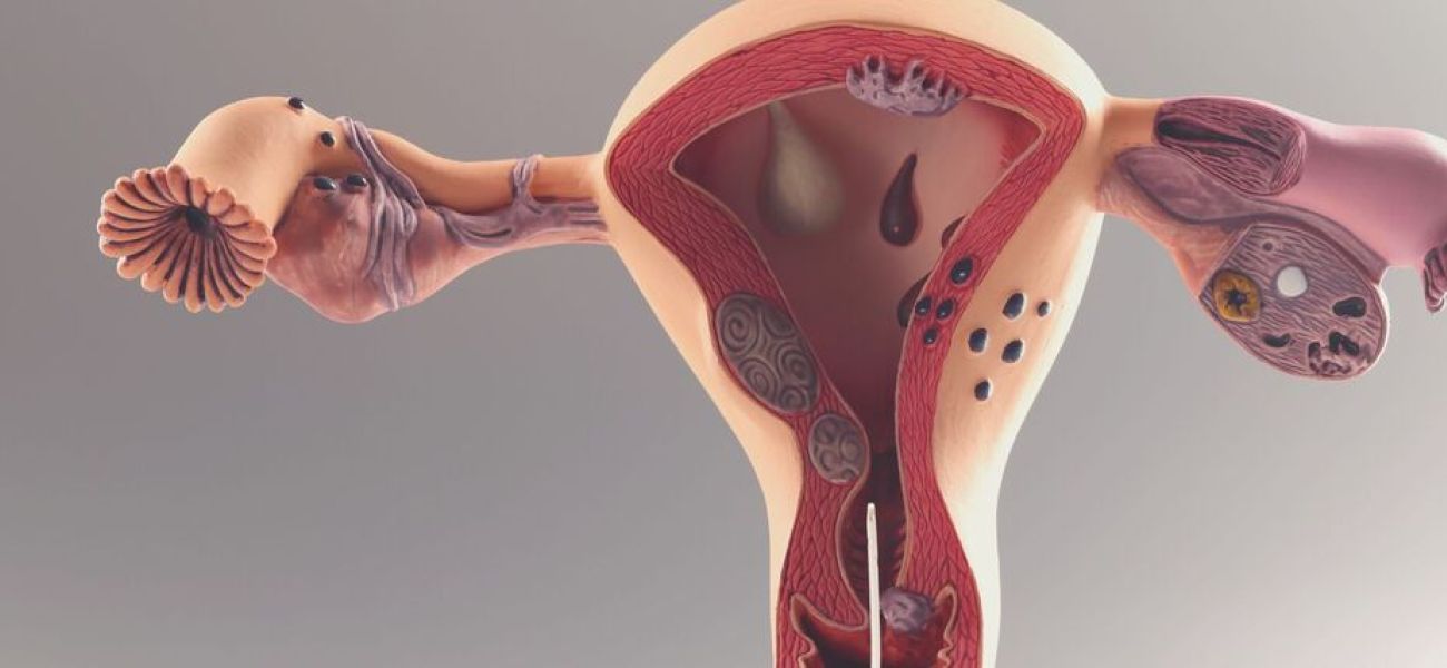 endometrio