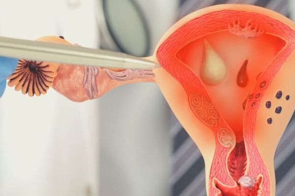 endometrite cronica